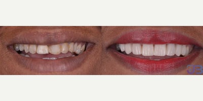 Woman treated with Porcelain Veneers - Porcelain Veneers and Dental Crowns combination was necessary to improve this beautiful lady.