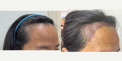 FUE hair transplant 1,700 grafts (Feminine hairline lowering) - A middle-aged Asian woman came in for a hair transplant shaven FUE technique with 1700 grafts to lower frontal hairline and create a feminine hairline.