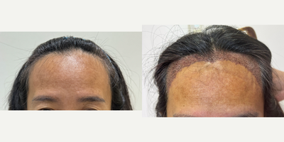 FUE hair transplant 1,700 grafts (Feminine hairline) - A middle-aged Asian woman came in for a hair transplant shaven FUE technique with 1700 grafts to lower frontal hairline and create a feminine hairline.