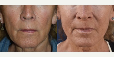 Los Angeles Sculptra for Cheeks and Jawline - This patient is 72 years old!  She was concerned with the way her lower face was looking.  She had some changes in the lower cheeks that created shadowy contours and also a jawline that was showing her jowls.