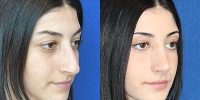 Woman treated with Rhinoplasty - Woman treated with Rhinoplasty