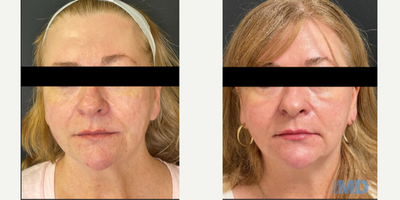 45-54 year old woman treated with NeoGen Plasma - This lovely patient received 1 NeoGen low energy treatment. She is please with the improved texture and tone of her skin. Reduced pigmentation is also to be noted!