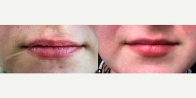 Woman treated with Restylane Silk - Woman treated with Restylane Silk
