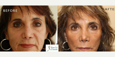 Woman treated with Nonsurgical Facelift - Woman treated with Nonsurgical Facelift