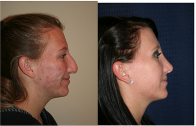 Rhinoplasty - Rhinoplasty