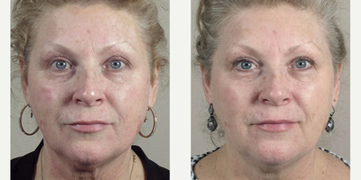 45-54 year old woman treated with Halo Laser - This patient was interested in improving the overall appearance of her skin. She was concerned with areas of hyperpigmentation as well as the beginnings of a saggy neck. She was treated with Ultherapy followed by Halo two weeks later. The combined treatments increased the firmness of her skin and eliminated brown spots.&nbsp;