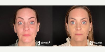 35-44 year old woman treated with Botox, Sculptra - The patient is a 42-year-old female who wanted to address concerns with facial volume loss and skin laxity. Dr. Chiang used Sculptra to treat her temples, cheeks, and jowls and Botox for her forehead, glabella, crow's feet, and under-eye areas.After photos are 2 weeks post treatment.