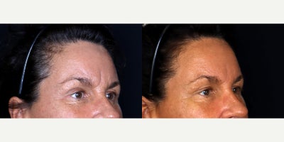 50 year old woman treated with Restylane Lyft to glabella - 50 year old woman treated with Restylane Lyft to glabella. Photos depict before and 1 month after treatment.