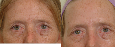 Pearl Laser Treatment - Pearl laser-one treatment