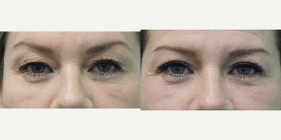 54 year old woman treated with Eyelid Surgery and lower eyelid fractional laser - This long time tobacco user consulted with us for rejuvenation of her eyes.  She complained of excess wrinkled skin and heaviness over her eyelids and looking tired all of the time. In the convenience of our Center, under local anesthesia with oral valium, we performed an upper blepharoplasty and lower eyelid fractional CO2 laser treatment. Her results demonstrate a well rested and natural result.
