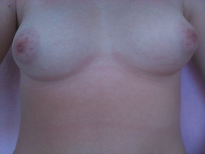 Fix Puffy Nipples 37