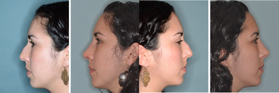 Post-Op Female Rhinoplasty and Septoplasty - Difficult primary rhinoplasty for a patient with previous nasal trauma, severe deviation and breathing problems. Bilateral spreader grafts, onlay grafts, tip graft, bilateral lateral crural strut grafts, and septoplasty.
