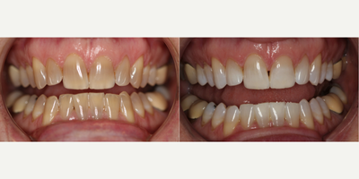 55-64 year old woman treated with Teeth Whitening - This patient was extremely self-conscious about her tetracycline staining. She has utilized several whitening options, but never saw any results. She was previously told her only option was to use porcelain, but the patient was hesitant to move forward with the treatment. Our office gave her the option of Kor Whitening, which is specifically for patients with tetracycline stain. Itwasfor her son's wedding and she isable to maintain this shade with whitening trays at home.