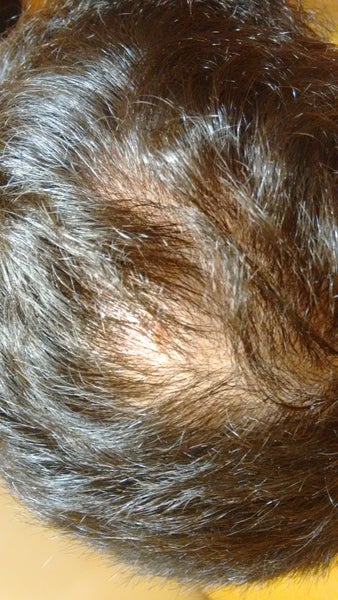 Could somebody please help diagnose my itchy, red, inflamed scalp with ...