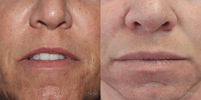 Dilated Pores Treatment using Chemical Peel - Skin pores allow the skin to breathe and to evacuate impurities. They can sometimes become clogged and dilated, giving the skin an irregular appearance. This condition can be effectively treated with chemical peels.