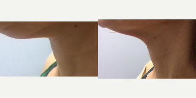 45-54 year old woman treated with Lipodissolve  - Lipodissolve injection of the Double chin (submental fat). Lipodissolve (i.e Kybella) involves injection of the solution in the submental fat area with reduction of the fat after a few sessions. Individual results may vary.