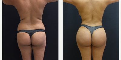 25-34 year old woman treated with Butt Lift - The patient underwent a Brazilian Butt Lift (butt augmentation with fat transfer). The combination of the liposculpting and the fat transfer gives her an hourglass figure. The Brazilian Butt Lift enhances your butt and transforms your entire shape!
