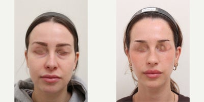 25-34 year old woman treated with AccuLift, Nonsurgical Facelift - Chief Complain: uneven face lines, hollowed under eyes, chubby cheeks, squared face shapeTreatment Plan: facial fat graft, under eye fat reposition, face liposuction ( cheeks, double chine, nasolabial folds) Outcome: - smooth V-lined face line - younger and refreshed look