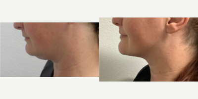 25-34 year old woman treated with Liposuction of the chin - 25-34 year old woman treated with Liposuction of the chin