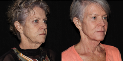 55-64 year old woman treated with SmartSkin, LED Light Therapy - This patient received SmartSkin CO2 Laser Skin Resurfacing, along with TriWave LED light therapy sessions to help speed her healing. This result is still developing as the after images are 12 days post procedure. She will be building additional collagen from this one procedure for 3 months with continued smoothing and tightening expected.