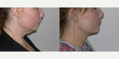 46 year old woman treated with Kybella - 46-year-old female shown before and 30 days after her second treatment with Kybella. Her height is 53 and weight 165 pounds. She received two vials per session and thirty days apart. She experienced minor bruising and swelling for 5-6 days after each injection. The patient iced immediately after the injections. A local anesthetic was used.
