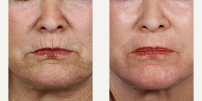 J Plasma Renuvion Skin Resurfacing - Perioral smoker's lines treated with J Plasma skin resurfacing technique to erase away those deep, coarse wrinkles and lines