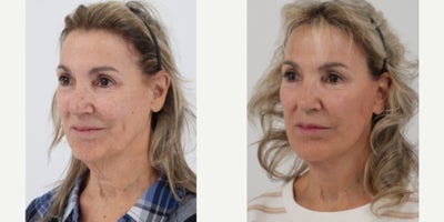 65-74 year old woman treated with Facelift, Neck Lift, TCA Peel - 71 year old 6 months post deep plane facelift, neck lift & TCA Jessner Peel by Dr. Dilip D. Madnani, MD FACS.