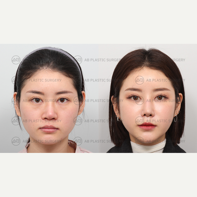 18-24 year old woman treated with Canthoplasty, Cheekbone Reduction, Revision Rhinoplasty, Facial Fat Transfer - By: Dr. Ahn Seung Hyun, Dr. Kim Joo Yeon, Dr. Bae In Ho