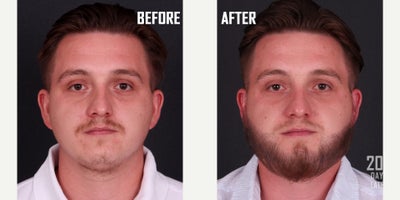 25-34 year old man treated with Beard Transplant - Beard transplant with FUE technique