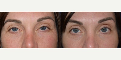 35-44 year old woman treated with Chemical Peel - This pleasant young lady began noticing the fine crepey skin changes under her eyes and did not want the risks of lasersnear her eyes. Following a medium depth chemical peel and healing, her new skin has a softer appearance.