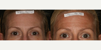 Woman treated with Sofwave - Photo provided courtesy of Sofwave, performed by Roy Geronemus, MD