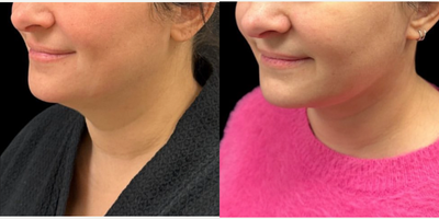 35-44 year old woman treated with Necklift - Necklift