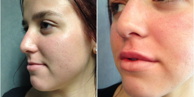 18-24 year old woman treated with Lip Augmentation - lip augmentation
