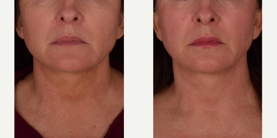 Woman treated with Halo Resurfacing Laser - The Halo Resurfacing Laser targets fine lines and wrinkles, pore size, and brown spots. Our patient came to Rejuva looking to reduce her years of sun damaged sun. After having done the Halo, our patient has seen significant improvement to the fine lines around her mouth, chin, and neck. Not to mention huge turnover for the brown spots to the face, neck, and chest. The Halo laser comes with minimal to no downtime. Results shown present before and 1 month after initial treatment.