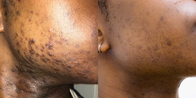 25-34 year old woman treated with Laser Hair Removal - A woman who suffers from PCOs has excessive hair growth, by having laser hair removal treatment, she gets rid of the ingrown hair and excessive hair on her face.