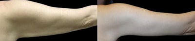 Woman treated with Arm Lift - Woman treated with Arm Lift