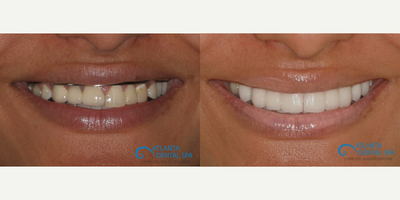 35-44 year old woman treated with Da Vinci Veneers - Before & After images