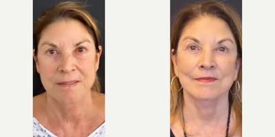 Woman treated with Facial Fat Transfer - Woman treated with Deep Plane Facelift, Neck Lift, Brow Lift, Lip Lift, and Facial Fat Transfer. Post-op, patient looks refreshed.