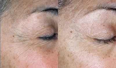 55-64 year old woman treated with SkinMedica - 