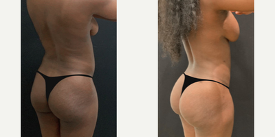 Woman treated with Mommy Makeover - Woman treated with Mommy Makeover through Mastopexy, Brazilian Butt Lift, andTummy Tuck.
