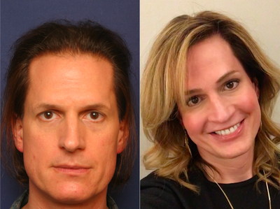 Facial Feminization Surgery - Before and After Facial Feminization