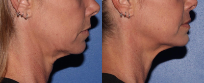 45-54 year old woman treated with Intracel - Patient did Intracel on her lower face/neck for tightening