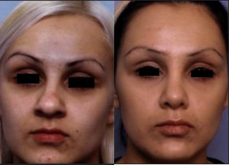Rhinoplasty - 	Before and after rhinoplasty