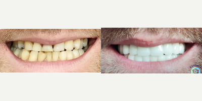 35-44 year old man treated with Dental Crown, Dental Bridge, Smile Makeover - Crown Type: ZirconiumShade: OM1