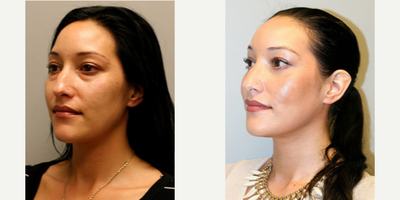Woman treated with Fractional Laser - Woman treated with Fractional CO2 Laser Resurfacing as well as Transconjunctival Blepharoplasty. Pre-op, patient was interested in treating her eye bags and the tired appearance of her eyes.
