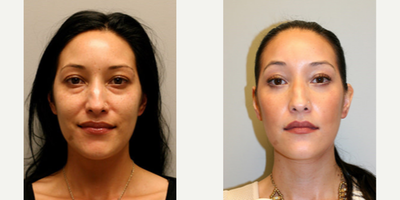 Woman treated with Fractional Laser - Woman treated with Fractional CO2 Laser Resurfacing as well as Transconjunctival Blepharoplasty. Pre-op, patient was interested in treating her eye bags and the tired appearance of her eyes.