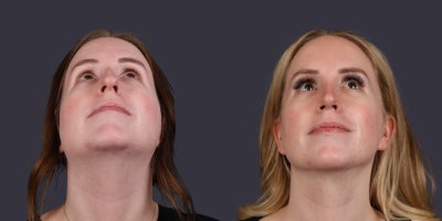 25-34 year old woman treated with Chin Liposuction, Rhinoplasty - This 28 year old woman is 5'2 and 158 pounds. She wanted a reduced hump and refined tip of her nose as well as reduced neck fullness. She had a rhinoplasty and submental liposuction done.