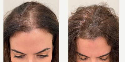 35-44 year old woman treated with Scalp Micropigmentation - SMP done for female thinning