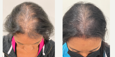 55-64 year old woman treated with Scalp Micropigmentation - SMP done for female thinning