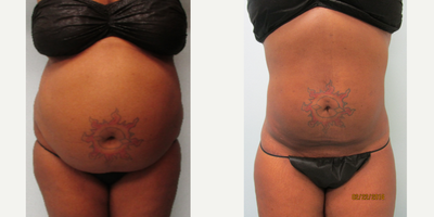 Lipo 360 No Cutting, Tummy Tuck Alternative! - Pt is 2 months out from Lipo only. This was done awake, under local anesthesia. She had her abdomen done first and then her back done 2 weeks later due to volume limitations. 2-3 day recovery time after each procedure.